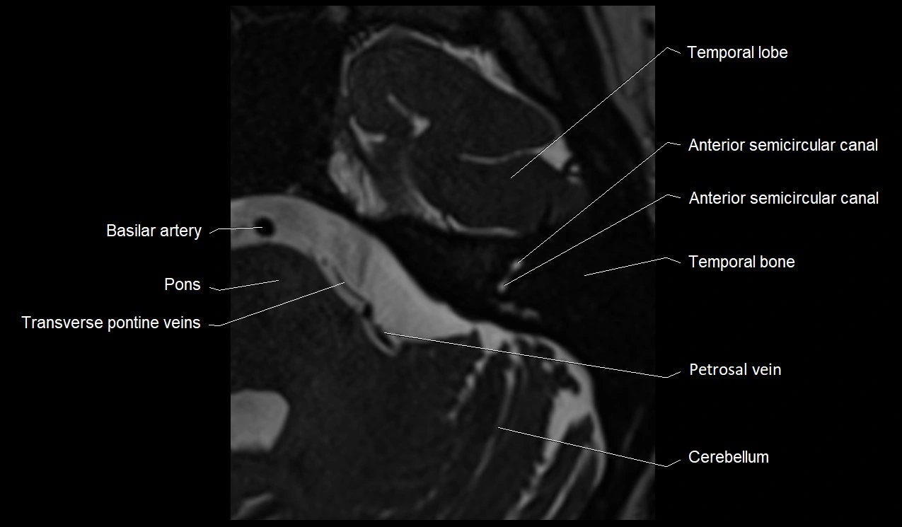 Internal auditory canal (IAC) axial cross sectional anatomy image 26.webp